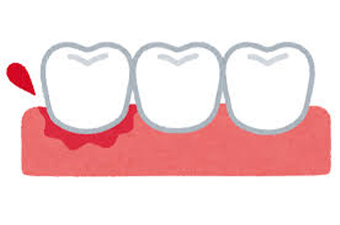 歯肉の修復再生